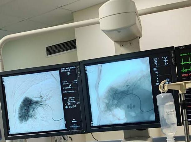  نجاح علاج ورم بالكبد لمريض باستخدام الحقن الشرياني بالإسماعيلية