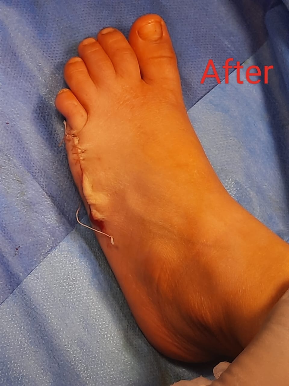 قدم الطفل بعد إجراء العملية