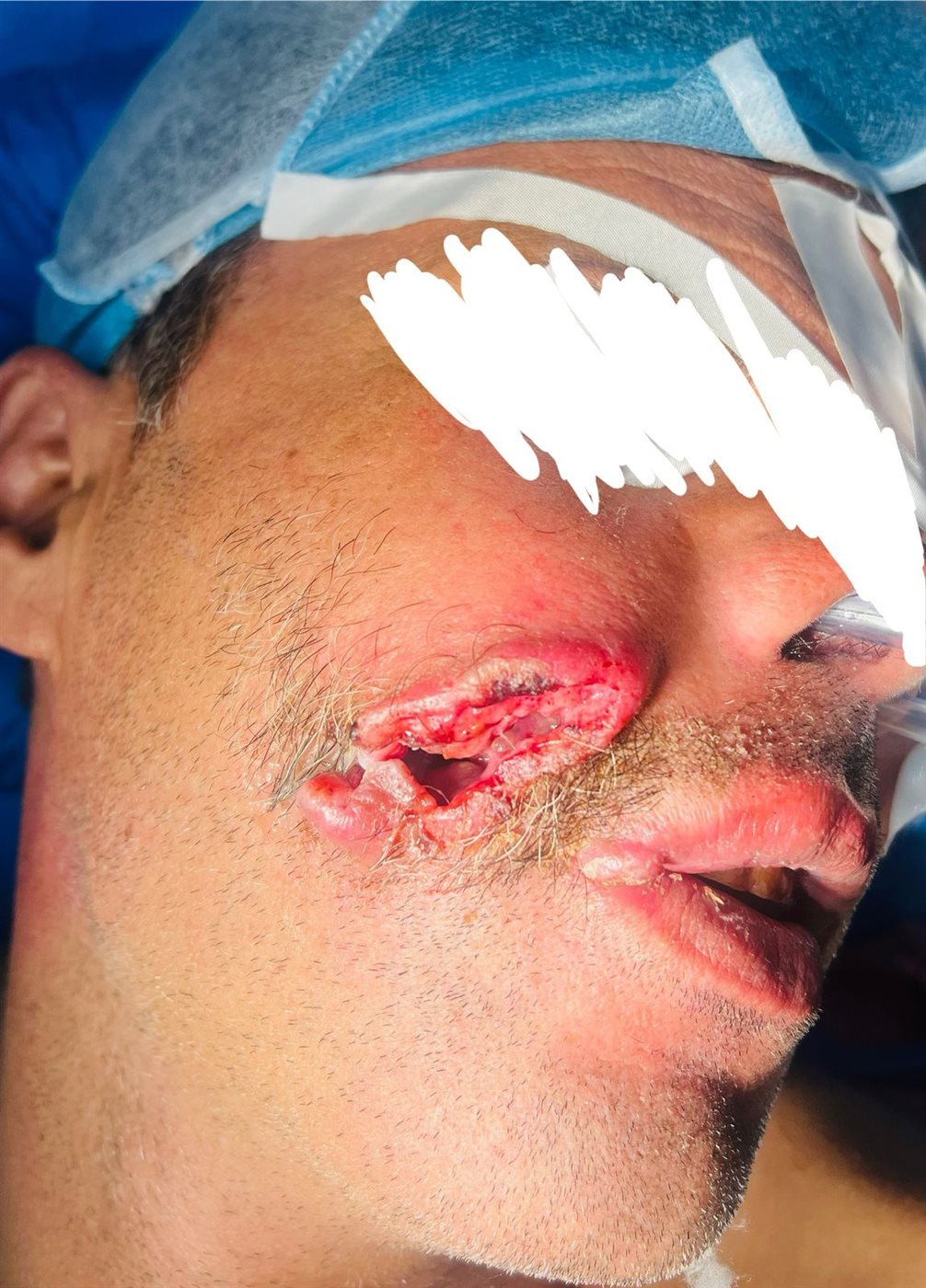 الجراحة شملت استئصال الورم بالكامل