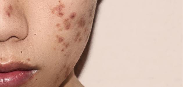 كيفية التخلص من آثار الحبوب.. مشكلة تؤرق الكثيرين