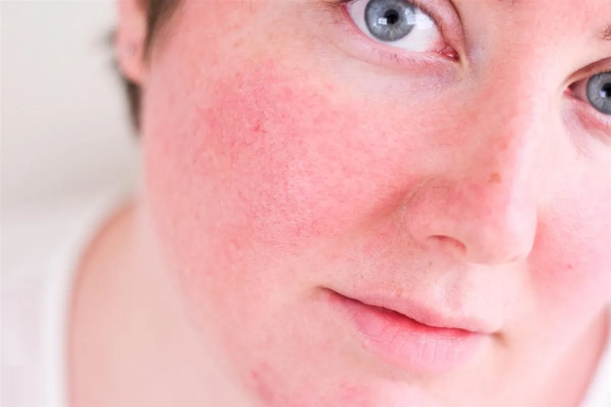 كيفية التعامل مع البشرة الحساسة في فصل الصيف.. دليلك الكامل للحماية والنضارة