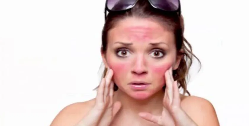 أضرار أشعة الشمس تهدد بشرة الأطفال