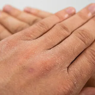 جفاف البشرة في الصيف.. كيف نحمي بشرتنا من فقدان الترطيب؟