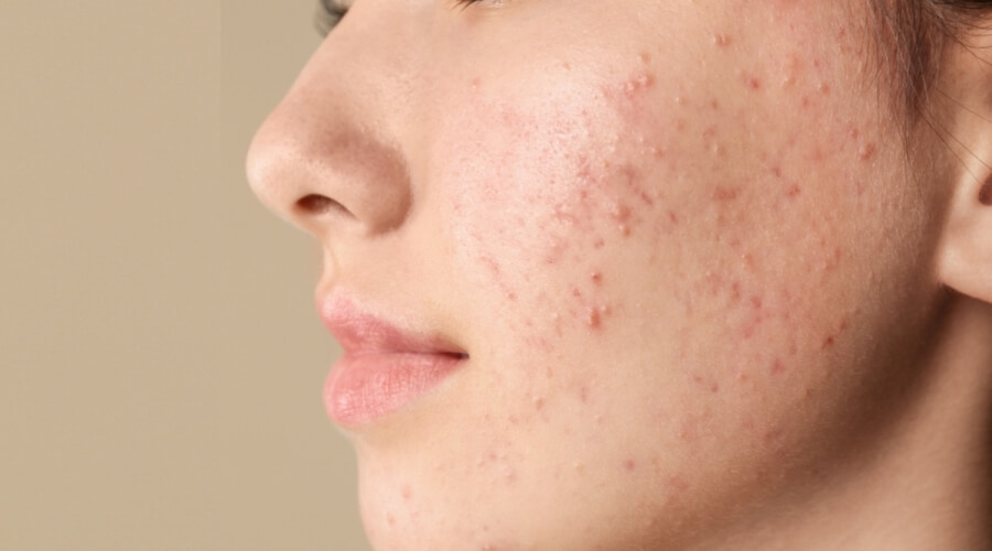 مشاكل البشرة الشائعة في مرحلة المراهقة