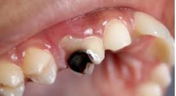 تأثير مرض السكري على الأسنان