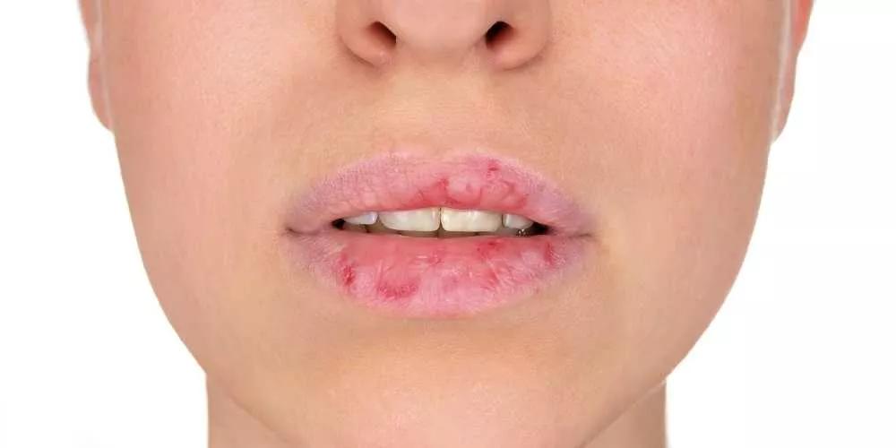 تشقق الشفاه في فصل الشتاء: الأسباب والعلاج وطرق الوقاية الطبيعية