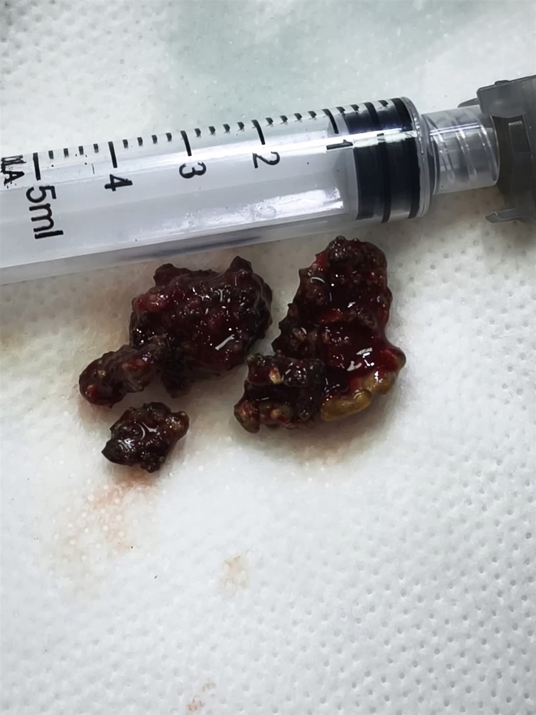 استخراج جسم غريب من انف المريضة 