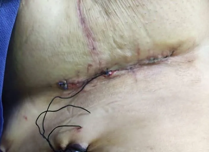 التدخل المحدود لعملية تغيير صمام ميترالي بمستشفي جامعة بني سويف&nbsp;