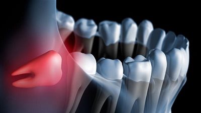 متى ينبغي خلع ضرس العقل؟