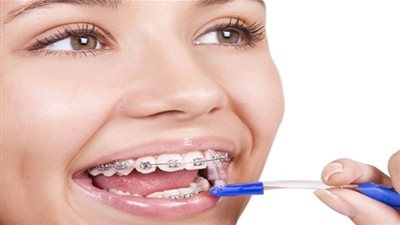 تعرف على مراحل تقويم الأسنان 