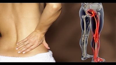 6 نصائح لعلاج آلام عرق النسا 