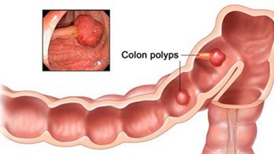 الكركم والمحار أفضل أطعمة لمكافحة سرطان القولون