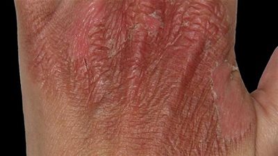  6 طرق لأخفاء اثار الحروق فى الجسم .. تعرفوا عليها