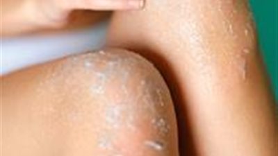 الخلطة السحرية لتبيض الاماكن السوداء كالركبة وتحت الباط