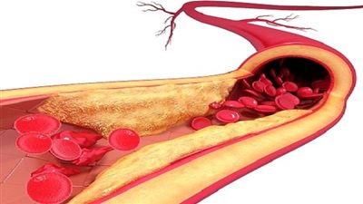  5 نصائح ذهبية للوقاية من الإصابة بمرض تصلب الشرايين