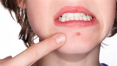  3 خطوات للتخلص من آثار الحبوب والبقع نهائياً