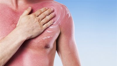  5 وصفات طبيعية للتخلص من حروق الشمس