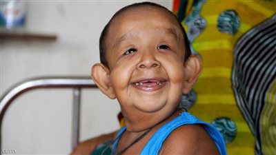 الطفل المسن.. لغز حيّر الأطباء في بنغلادش