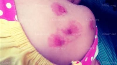 ننشر صور الطفلة المتعدى عليها بحضانة في سوهاج 