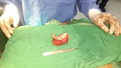 مستشفيات الصحة بالإسكندرية تجرى أول عملية جراحية لإزالة ورم بالفك