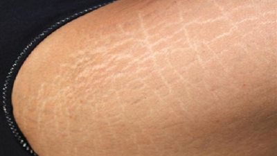 أفضل 10 طرق للتخلص من السيلوليت.. تعرفي عليها