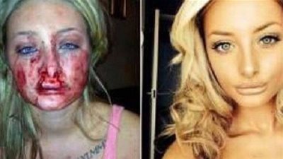 فتاة بريطانية قبّلها حبيبها بوحشيّة حتى اقتلع شفتيها .. والسبب صادم!