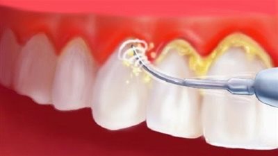 4 طرق طبيعية لإزالة الجير من الأسنان