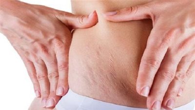 علاج طبيعي للتخلص من السيلوليت نهائيًا