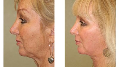 تعرفي على مميزات وعيوب التقشير الكيميائي للبشرة