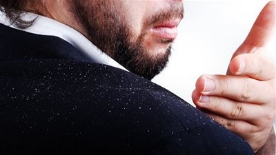 5 طرق طبيعيّة للقضاء على قشرة الرأس نهائياً