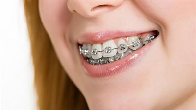 تحذير .. مرضى تقويم الأسنان تجنبوا هذه الأطعمة 