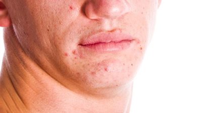 دراسة: حب الشباب يحافظ على شباب البشرة