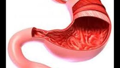 لتجنب التهاب القولون احذرى تلك الأطعمة