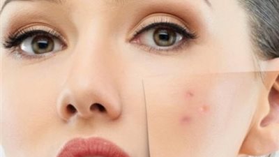 حب الشباب يحمي بشرة الإنسان من الشيخوخة