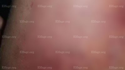 نشطاء يتداولون صورًا لطفلة 3 سنوات تعرضت للضرب من مُدرس بحضانة في البحيرة (صور)