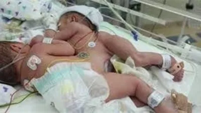 اليوم.. المملكة تشهد أعقد عملية فصل توأم سيامي