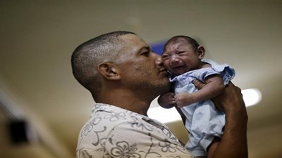 الإعلان عن أول حالة صغر رأس مرتبطة بفيروس 