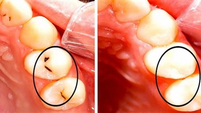 دون الحاجة إلى طبيب.. تخلصي من تسوس الأسنان في 5 دقائق