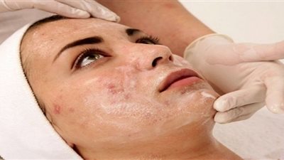 نقص الأوكسجين قد يؤدي لتكاثر البكتيريا المسببة لحب الشباب