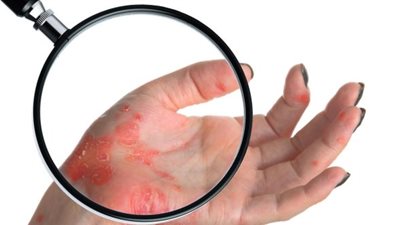 7 أطعمة تؤثر على مرض الصدفية