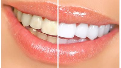 تعرف على طرق طبيعية لتبييض الأسنان