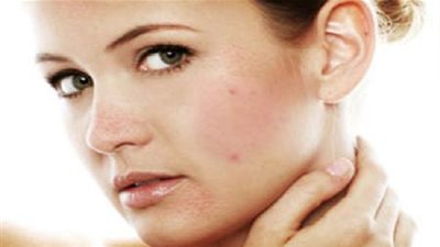 دراسة.. العلاج المنزلي لحَبّ الشباب يستوجب إشراف الطبيب