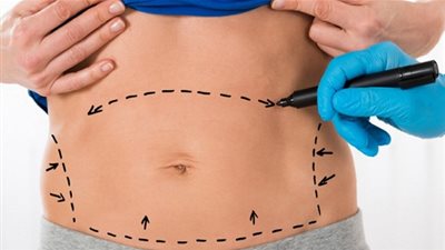 3 حقائق مهمة قبل اللجوء إلى عملية شد البطن