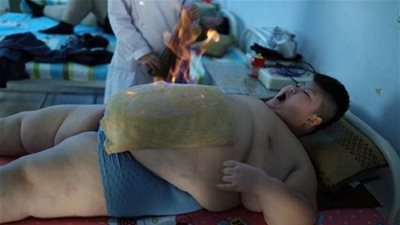 طفل صيني يُعاني من السمنة المفرطة يُعالج بالنار