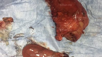 التأمين الصحي بالقليوبية ينجح في إجراء أول عملية استئصال ورم خبيث من البنكرياس (صور)