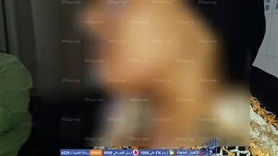 تفاصيل إجراء أول عملية بمصر لاسئصال غدة الدرقية بالمنظار بالأورام جامعة المنصورة