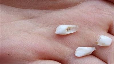 يُفضل الاحتفاظ بأسنان الأطفال اللبنية بعد سقوطها.. لهذا السبب!