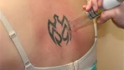 طرق إزالته الوشم  من الجسم.. تعرفي عليها !