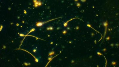 ما الحل لحساسية الحيوانات المنوية؟