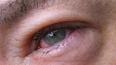 «إنفلونزا العيون».. الفيروس الذي لا علاج له !